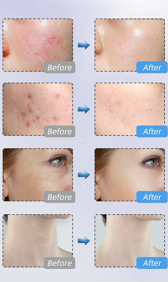 Before and after comparison of skin treatment effects on various parts of a person's face.