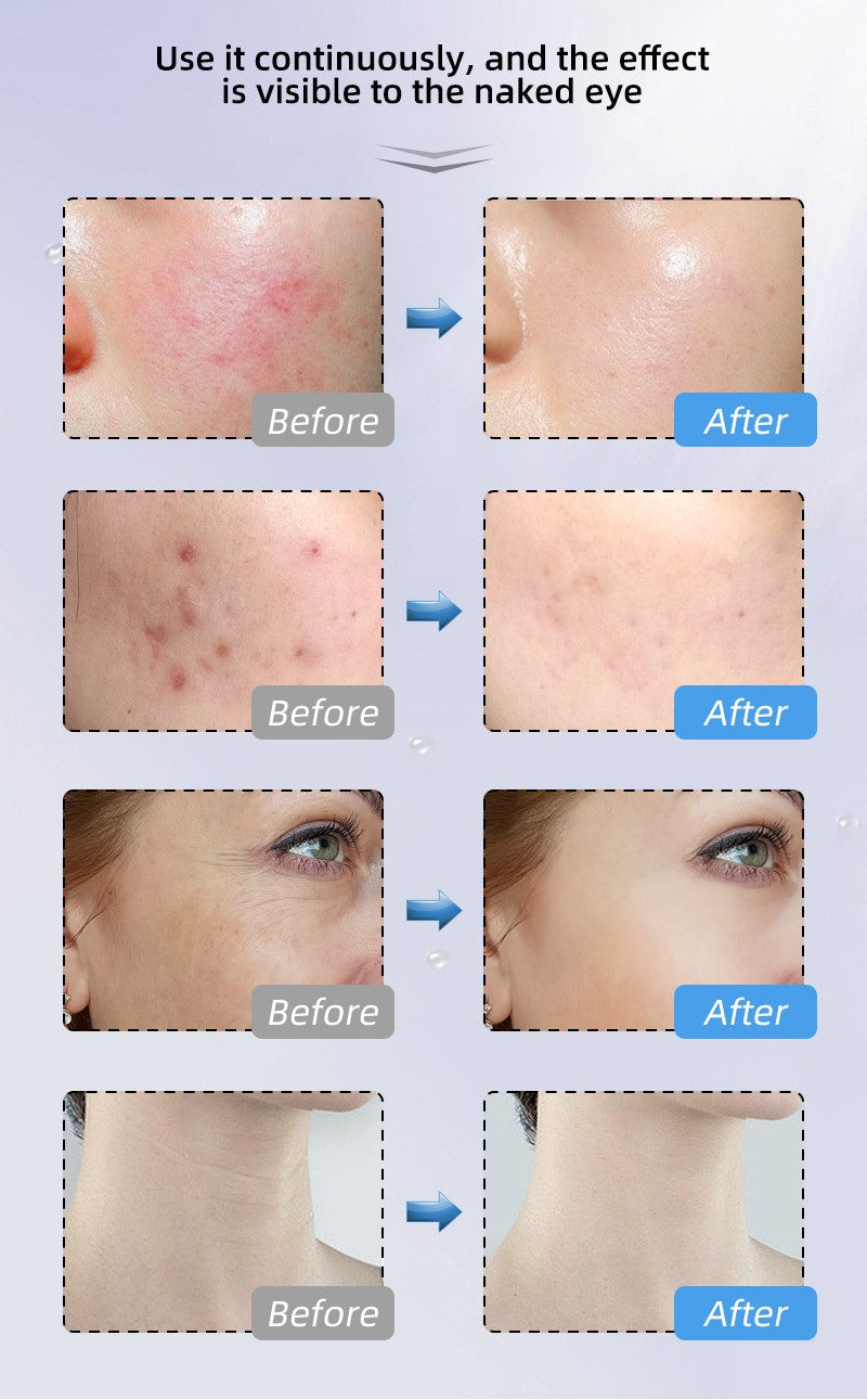 Novalight Pro LED Mask 2.0 - FDA Approved