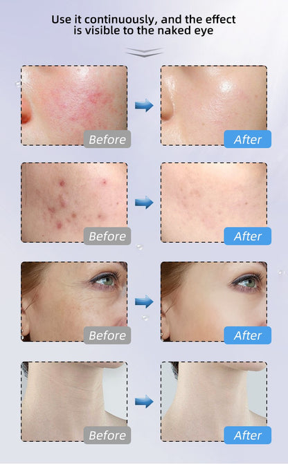 Novalight Pro LED Mask 2.0 - FDA Approved