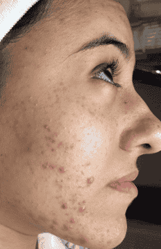 acne