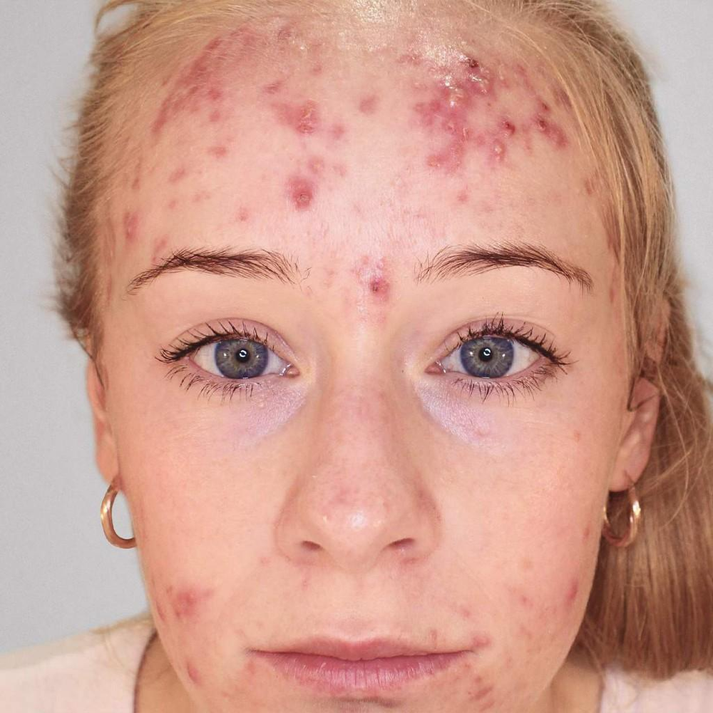 Person with acne on their face